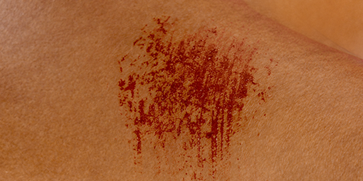 Gros plan de griffures rouges sur une peau pâle. Gros plan de griffures rouges sur une peau pâle.